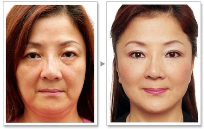 肉毒桿菌注射有哪些注意事項