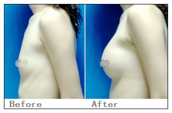 假體隆胸有哪些適宜人群