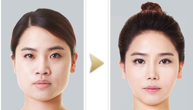 下頜角整形手術(shù)方法