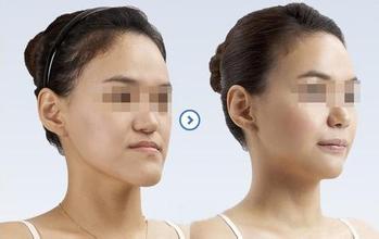 地包天矯正有哪幾種類型