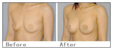 假體隆胸手術(shù)有什么危害