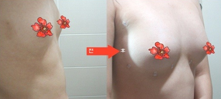 假體隆胸有什么優(yōu)點(diǎn)