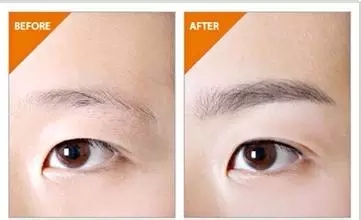 眉毛種植對(duì)比照
