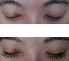 種植睫毛適應(yīng)哪種人群