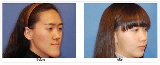 地包天矯正危害有哪些