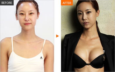 乳房再造幾種手術(shù)方法