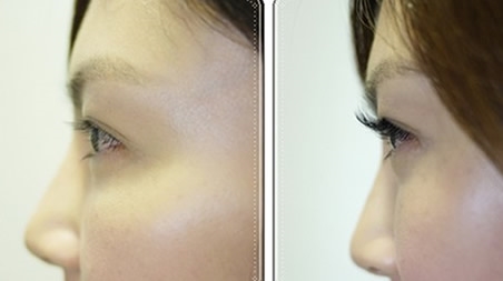 睫毛種植有什么手術(shù)方式