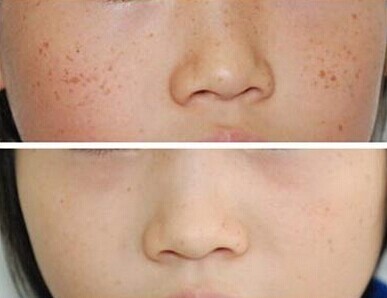 激光手術(shù)治療色素痣有什么禁忌癥?