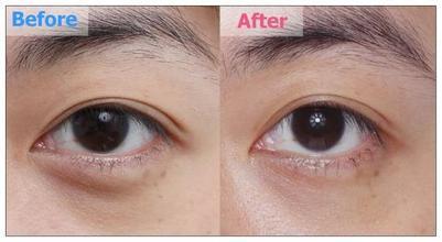 孫鵬激光去黑眼圈多少錢 - 珍美網(wǎng)