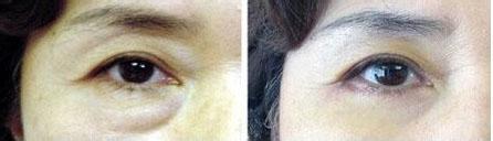 激光去黑眼圈的效果如何