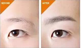 眉部整形價(jià)格多少錢