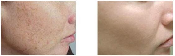 激光去色素價(jià)格是多少