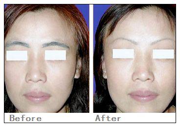 韓式切提眉術(shù)優(yōu)勢(shì)有哪些