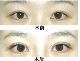 睫毛種植的價(jià)格是多少