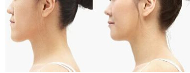 地包天矯正費用多少錢呢