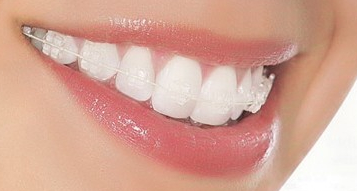 牙齒矯正術(shù)后麻煩多 如何解決 - 珍美網(wǎng)