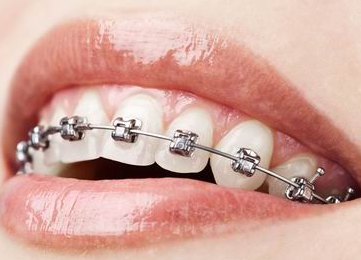 牙齒矯正術(shù)后麻煩多 如何解決