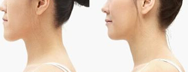 地包天矯正后的注意事項有哪些?