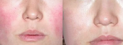 光子祛紅血絲有哪些優(yōu)勢