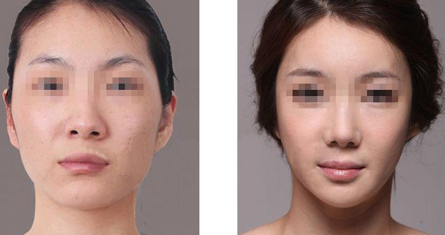 韓式切眉術(shù)和普通切眉術(shù)有什么區(qū)別呢