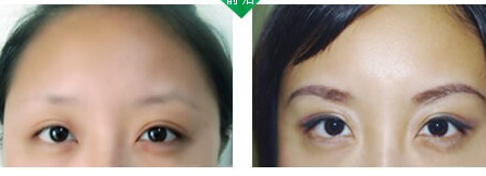 眉毛種植效果怎么樣呢