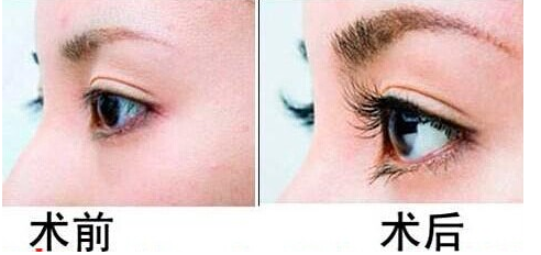 常見的睫毛移植方法有哪些