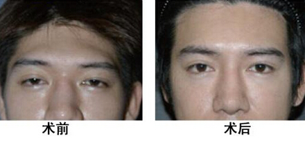 隆眉弓的效果是怎么樣