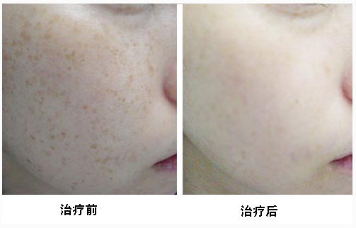 彩光祛斑好處有哪些 - 珍美網