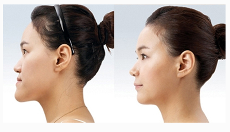 地包天牙齒矯正有沒有年齡限制呢