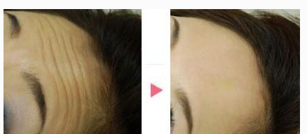 激光除皺有沒有危害呢