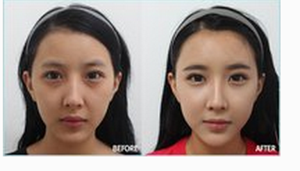 玻尿酸豐臥蠶效果好不好