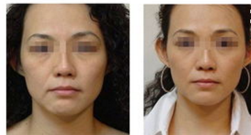 激光除皺手術(shù)效果怎么樣