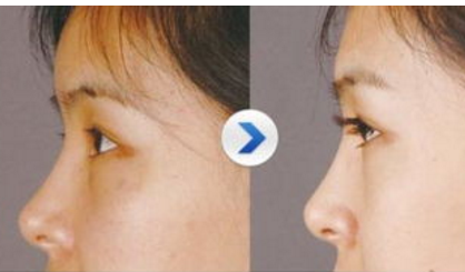 種植睫毛術(shù)維持多久時(shí)間