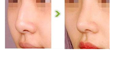 鼻骨整形手術(shù)有沒(méi)有副作用