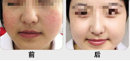 激光去紅血絲效果好不好