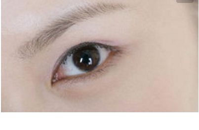 激光祛黑眼圈的好處有哪些 - 珍美網(wǎng)