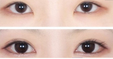 雙眼皮失敗修復(fù)手術(shù)效果怎么樣