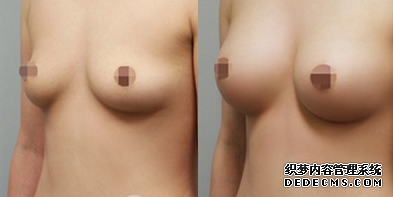 假體隆胸手術(shù)對比照