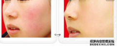 光子嫩膚去紅血絲效果怎么樣