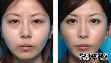 面部吸脂手術(shù)對(duì)比照