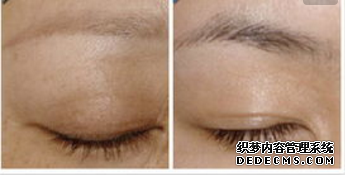 眉毛整形手術(shù)效果怎么樣