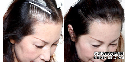 發(fā)際線種植手術(shù)效果好不好