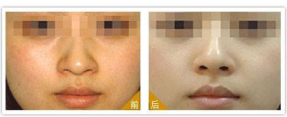 彩光嫩膚去紅血絲效果好不好