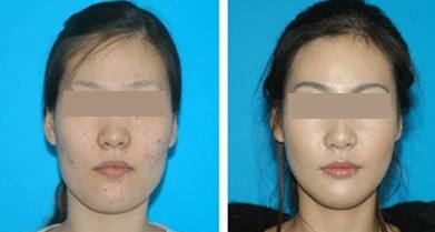 激光去除黑色素見(jiàn)效要多久