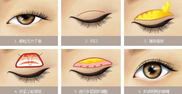 上瞼下垂矯正后需要多久眼睛才能完全閉合