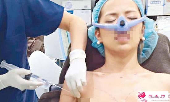 假體隆胸注意事項_哪些人不適合做假體豐胸