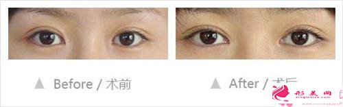 開內(nèi)眼角手術(shù)適合人群_開內(nèi)眼角手術(shù)適合哪些女性？