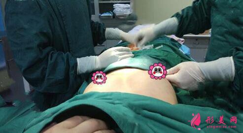 假體隆胸后需要注意的事項(xiàng)