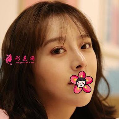 削骨手術效果怎么樣 案例圖