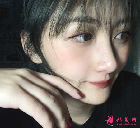 找南京黃金龍醫(yī)生做了隆鼻手術(shù)后，鼻子俊俏好看